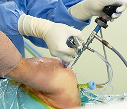 관절경 회전근개봉합술 진행과정3