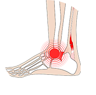 발목인대 손상 및 불안정증