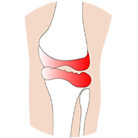 무릎연골판손상