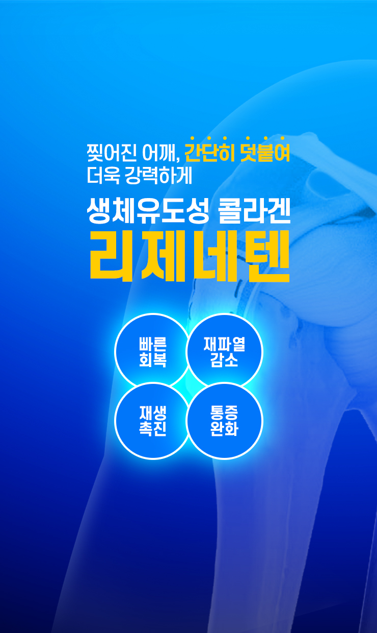 콜라겐 임플란트 패치보강술, 리제네텐(Regeneten)