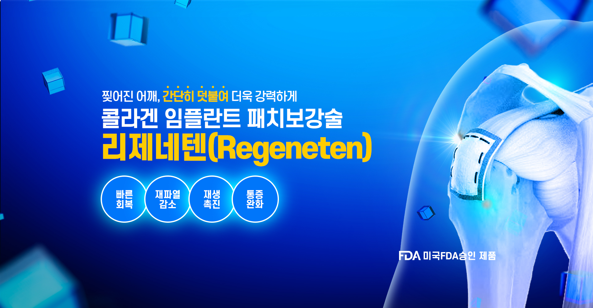 콜라겐 임플란트 패치보강술, 리제네텐(Regeneten)